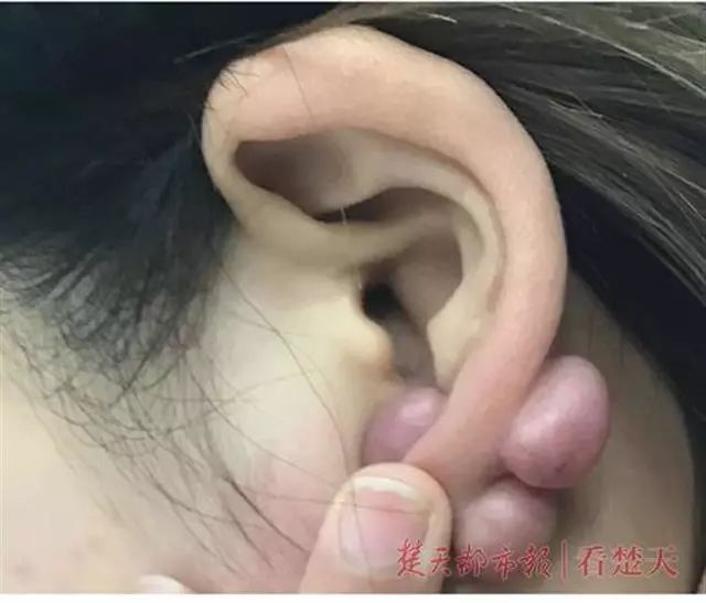 大学毕业后长了疙瘩(为什么毕业后就会长胖)